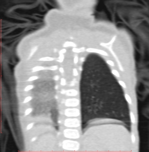 Bronchogenic cyst (Radiopaedia 78599-91409 Coronal lung window 184).jpg
