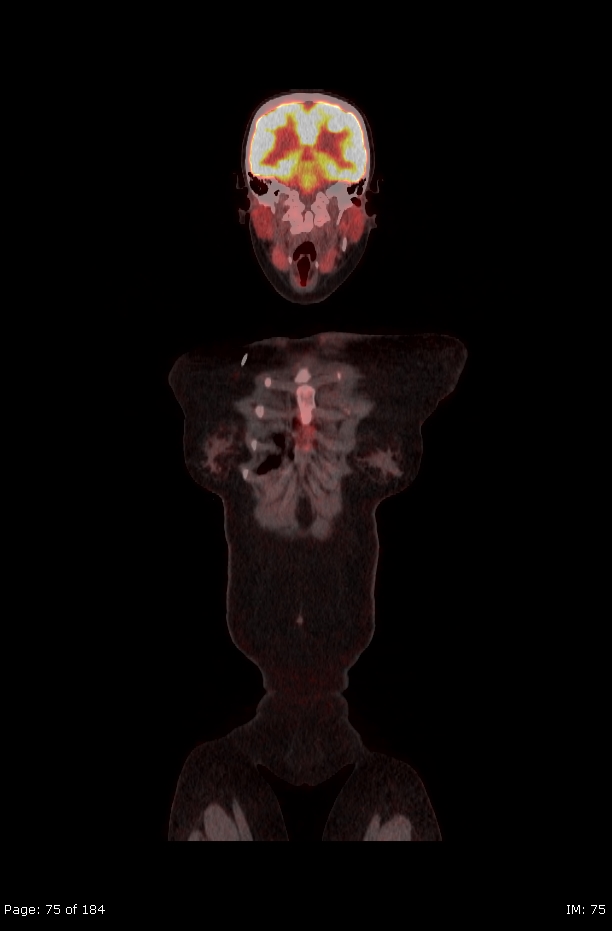 Brown fat uptake (FDG PET-CT) (Radiopaedia 77392-89513 Fused coronal 33).jpg