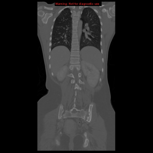File:Brown tumor (Radiopaedia 12318-12596 D 47).jpg