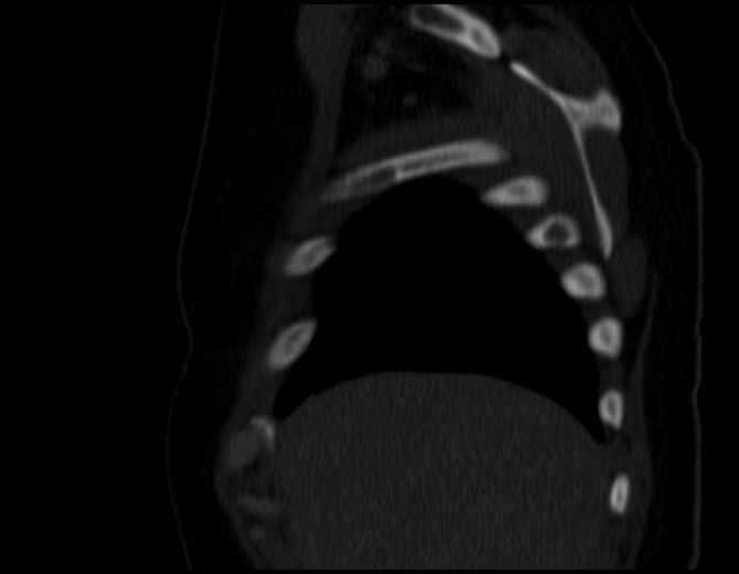 Brown tumors compressing the spinal cord (Radiopaedia 68442-77988 Sagittal bone window 11).jpg