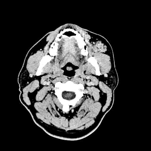 Buccal fat pad arteriovenous malformation (Radiopaedia 70936-81142 Axial non-contrast 18).jpg