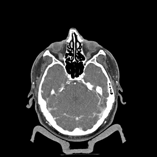 Buccal fat pad arteriovenous malformation (Radiopaedia 70936-81144 D 269).jpg