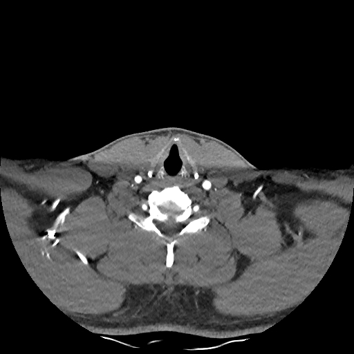 Buccal fat pad arteriovenous malformation (Radiopaedia 70936-81144 D 88).jpg
