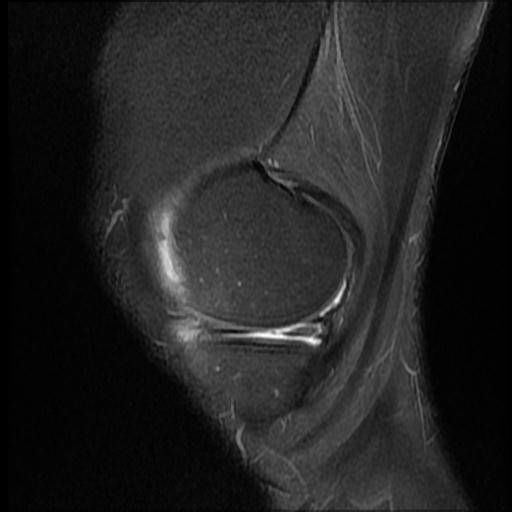 File:Bucket handle tear - medial meniscus (Radiopaedia 69245-79026 Sagittal PD fat sat 15).jpg