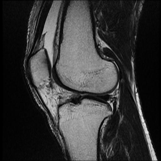 File:Bucket handle tear - medial meniscus (Radiopaedia 69245-79026 Sagittal T2 4).jpg