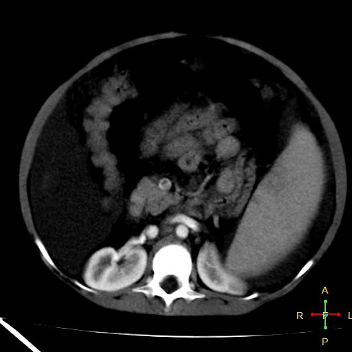 File:Budd-Chiari syndrome (Radiopaedia 23072-23103 C+ arterial phase 13).jpg