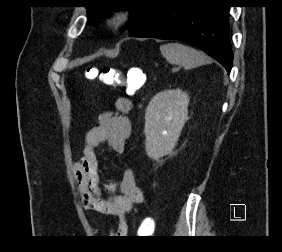 Buried bumper syndrome - gastrostomy tube (Radiopaedia 63843-72577 Sagittal Inject 25).jpg