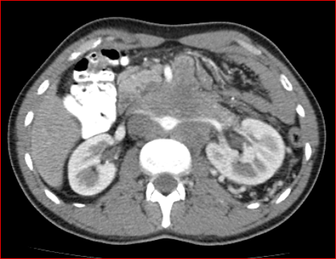 File:Burned-out testicular choriocarcinoma (Radiopaedia 32822-34040 B 7).PNG