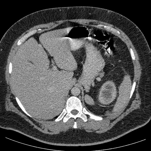 File:Burned-out testicular seminoma - retroperitoneal nodal metastases (Radiopaedia 62872-71245 A 16).jpg