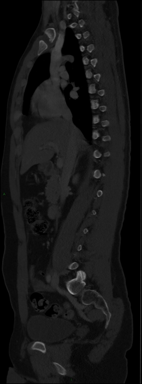 Burst fracture (Radiopaedia 83168-97542 Sagittal bone window 59).jpg