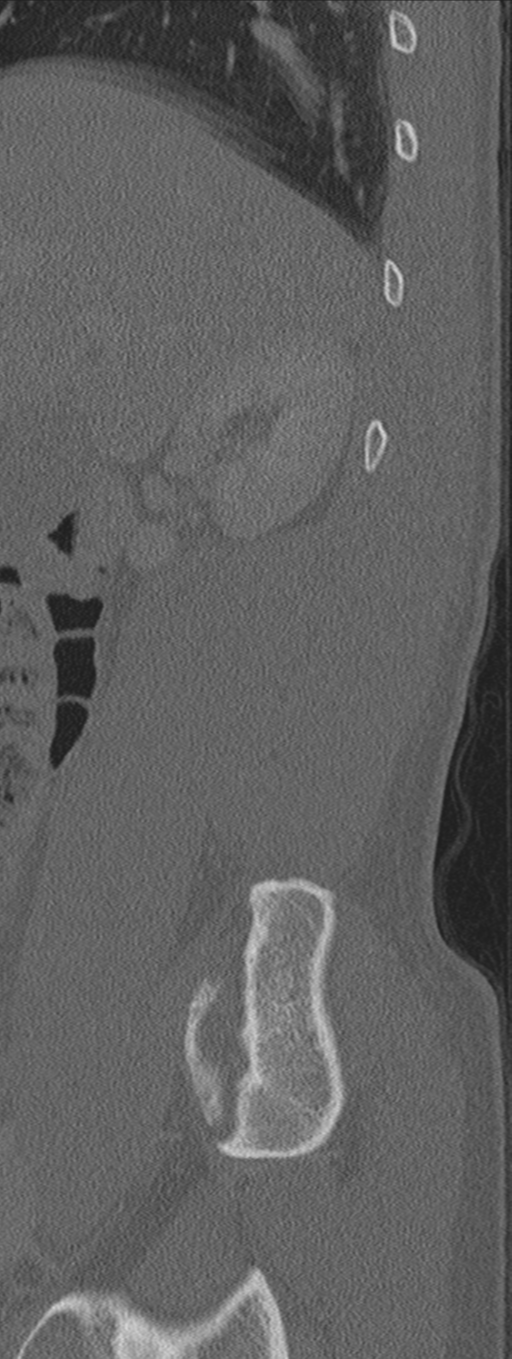 Burst fracture - T12 with conus compression (Radiopaedia 56825-63647 Sagittal bone window 79).png