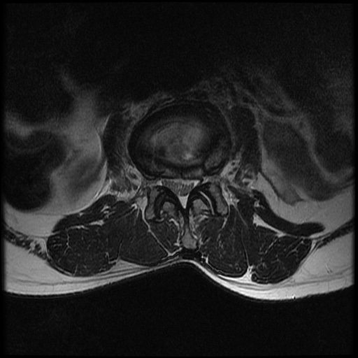 File:Burst fracture - lumbar spine (Radiopaedia 72877-83541 Axial T2 7).jpg