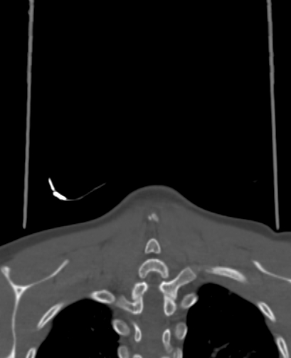 Butterfly vertebra (Radiopaedia 77903-90209 Coronal bone window 98).jpg