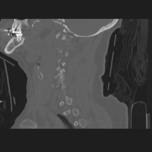 C2 fracture (Radiopaedia 34091-35341 Sagittal bone window 22).png