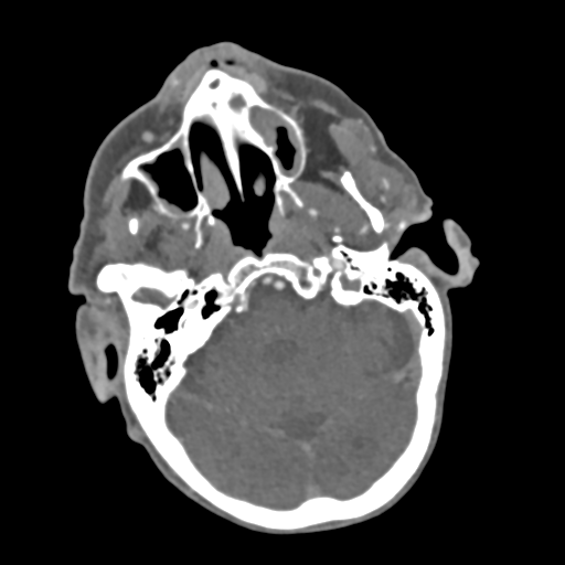 File:C2 fracture with vertebral artery dissection (Radiopaedia 37378-39200 A 206).png