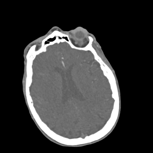 C2 fracture with vertebral artery dissection (Radiopaedia 37378-39200 A 260).png