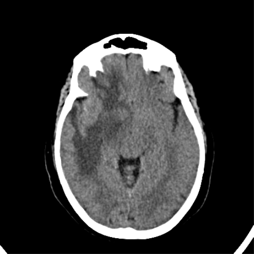 File:CNS Lymphoma (Radiopaedia 44198-47794 Axial non-contrast 17).png