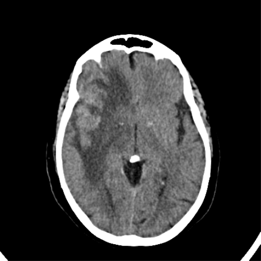 File:CNS Lymphoma (Radiopaedia 44198-47794 Axial non-contrast 18).png
