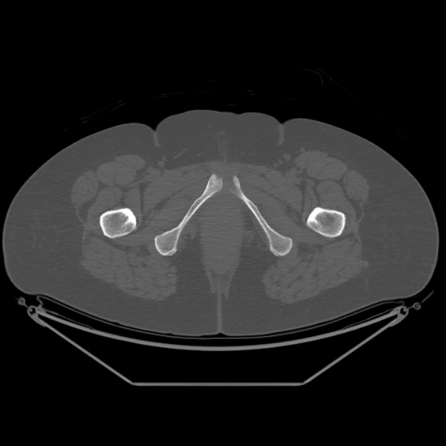 Calcific tendinitis of the gluteus medius muscle (Radiopaedia 66998-76318 Axial bone window 70).jpg