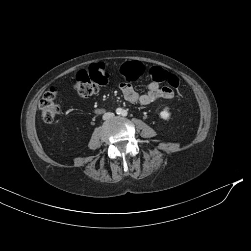 Calcified adrenal glands and Spigelian hernia (Radiopaedia 49741-54988 A 123).jpg