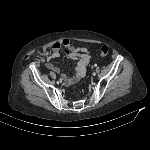 Calcified adrenal glands and Spigelian hernia (Radiopaedia 49741-54988 A 187).jpg