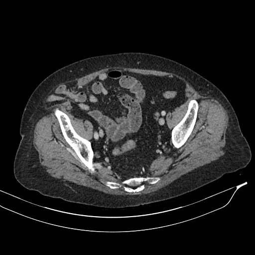 Calcified adrenal glands and Spigelian hernia (Radiopaedia 49741-54988 A 196).jpg