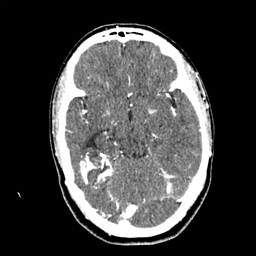 Calcified cerebral hydatid cyst (Radiopaedia 65603-74717 Axial with contrast 27).jpg