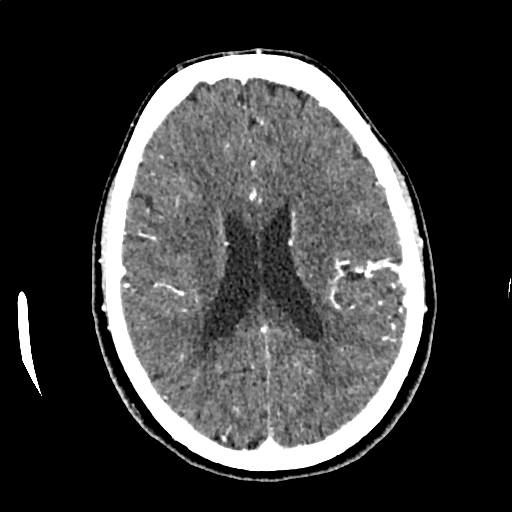 Calcified cerebral hydatid cyst (Radiopaedia 65603-74717 Axial with contrast 48).jpg