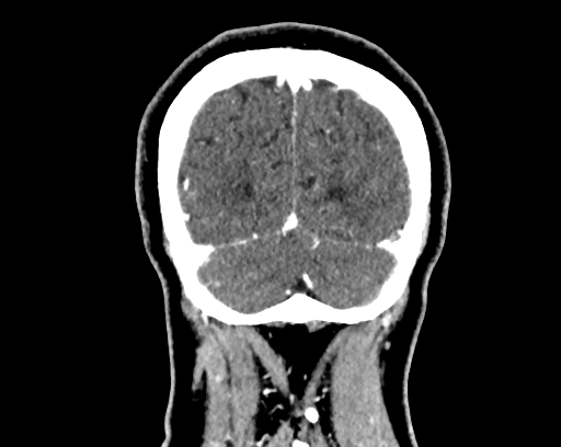 Calcified cerebral hydatid cyst (Radiopaedia 65603-74717 C 65).jpg