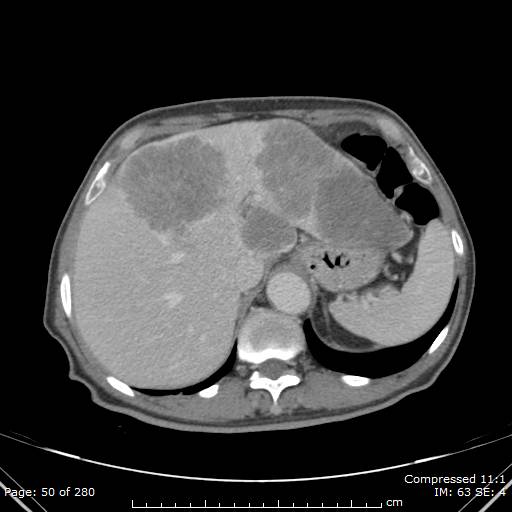 Calcified liver metastases (Radiopaedia 44699-48470 B 18).jpg