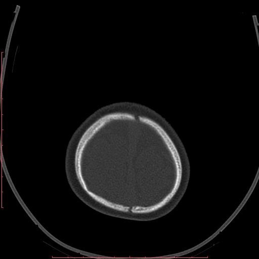 Calcified middle cerebral artery embolism (Radiopaedia 78949-91860 Axial bone window 68).jpg