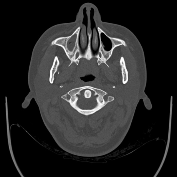 Calvarial osteoma (Radiopaedia 36520-38079 Axial bone window 4).jpg