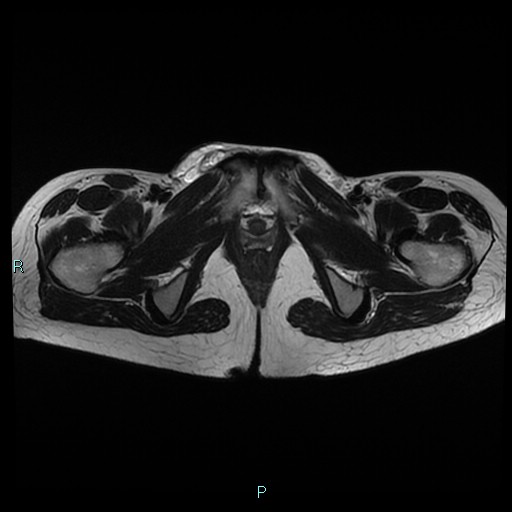 File:Canal of Nuck cyst (Radiopaedia 55074-61448 Axial T2 20).jpg