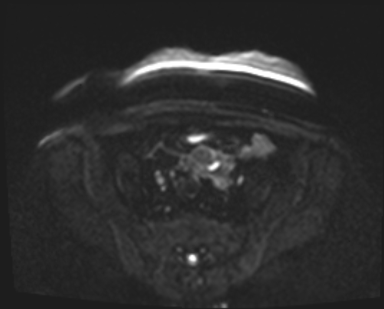 Cancer cervix - stage IIb (Radiopaedia 75411-86615 Axial DWI 24).jpg