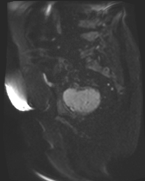 Cancer cervix - stage IIb (Radiopaedia 75411-86615 Sagittal DWI 63).jpg