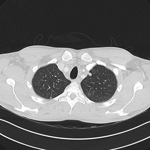 Cannonball metastases - testicular choriocarcinoma (Radiopaedia 84510-99891 Axial lung window 20).jpg