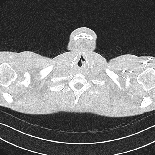 Cannonball metastases - testicular choriocarcinoma (Radiopaedia 84510-99891 Axial lung window 5).jpg