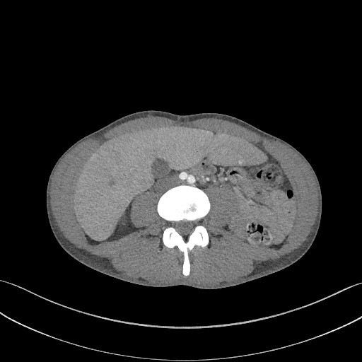 File:Cannonball metastases - testicular choriocarcinoma (Radiopaedia 84510-99891 B 141).jpg