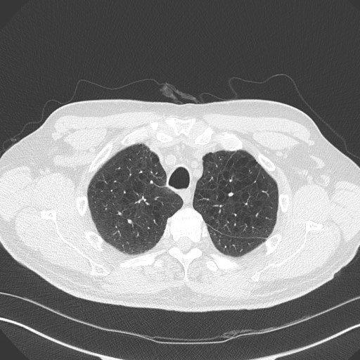 Caplan syndrome (Radiopaedia 56667-63530 Axial lung window 45).jpg