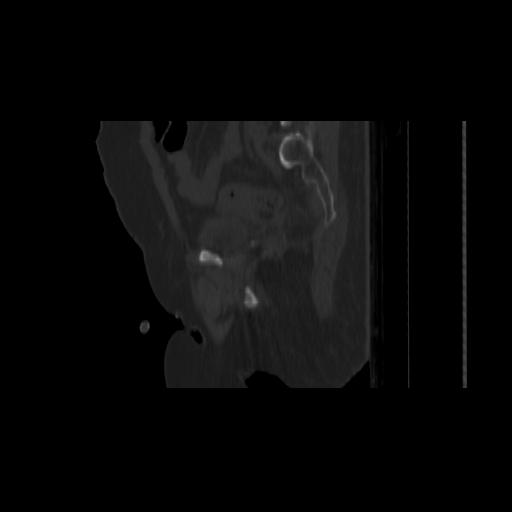 Carcinoma cervix- brachytherapy applicator (Radiopaedia 33135-34173 Sagittal bone window 126).jpg