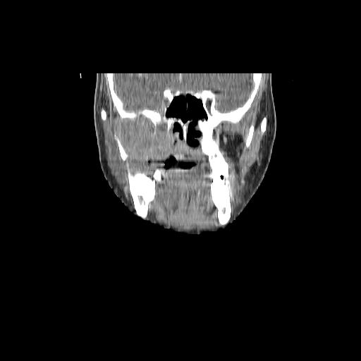 Carcinoma of the maxillary antrum (Radiopaedia 53805-59888 Coronal C+ delayed 58).jpg