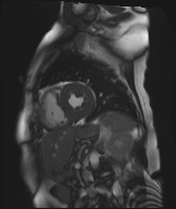 Cardiac amyloidosis (Radiopaedia 51404-57150 Sagittal CINE SSFP 157).jpg