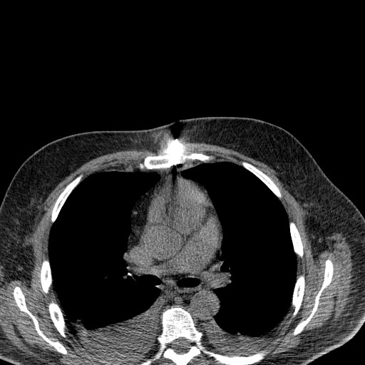 File:Cardiac lymphoma (Radiopaedia 38690-40840 Axial non-contrast 5).jpg