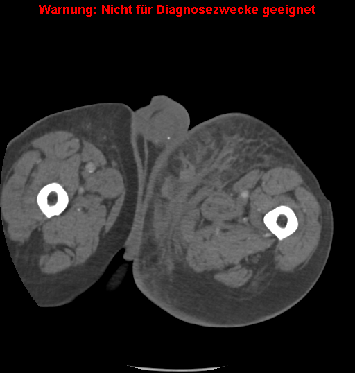 File:Cardiac perforation following transcatheter aortic valve implantation (Radiopaedia 23714-23863 B 35).png