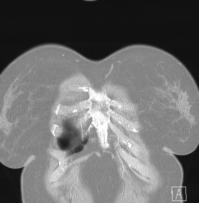 Cardiac sarcoidosis (Radiopaedia 74548-85534 Coronal lung window 2).jpg