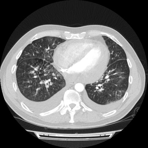 Cardiac tamponade (Radiopaedia 78607-91368 Axial lung window 59).jpg