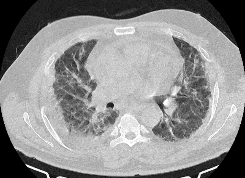 Cardiogenic pulmonary edema (Radiopaedia 68180-77678 Axial lung window 47).jpg