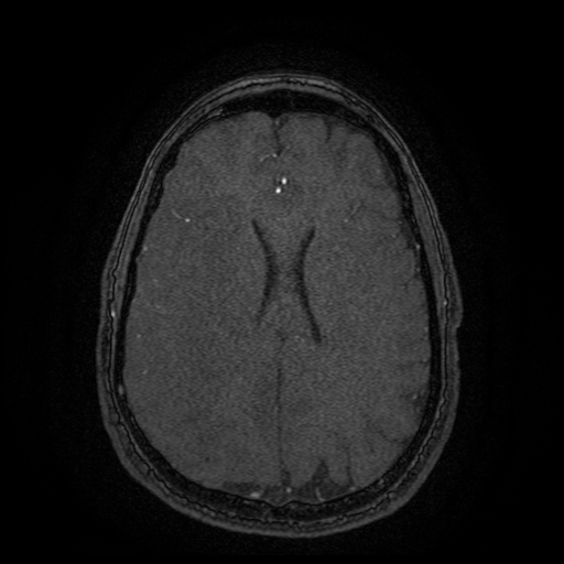 Carotid arterial dissection with acute cerebral infarction (Radiopaedia 26636-26784 MRA 47).jpg