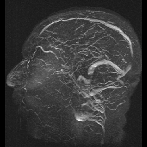 Carotid arterial dissection with acute cerebral infarction (Radiopaedia 26636-26784 MRV 4).jpg