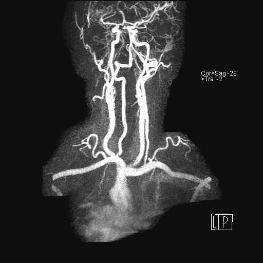 File:Carotid artery dissection (Radiopaedia 28441-28689 MIP Carotids MRA 22).jpg